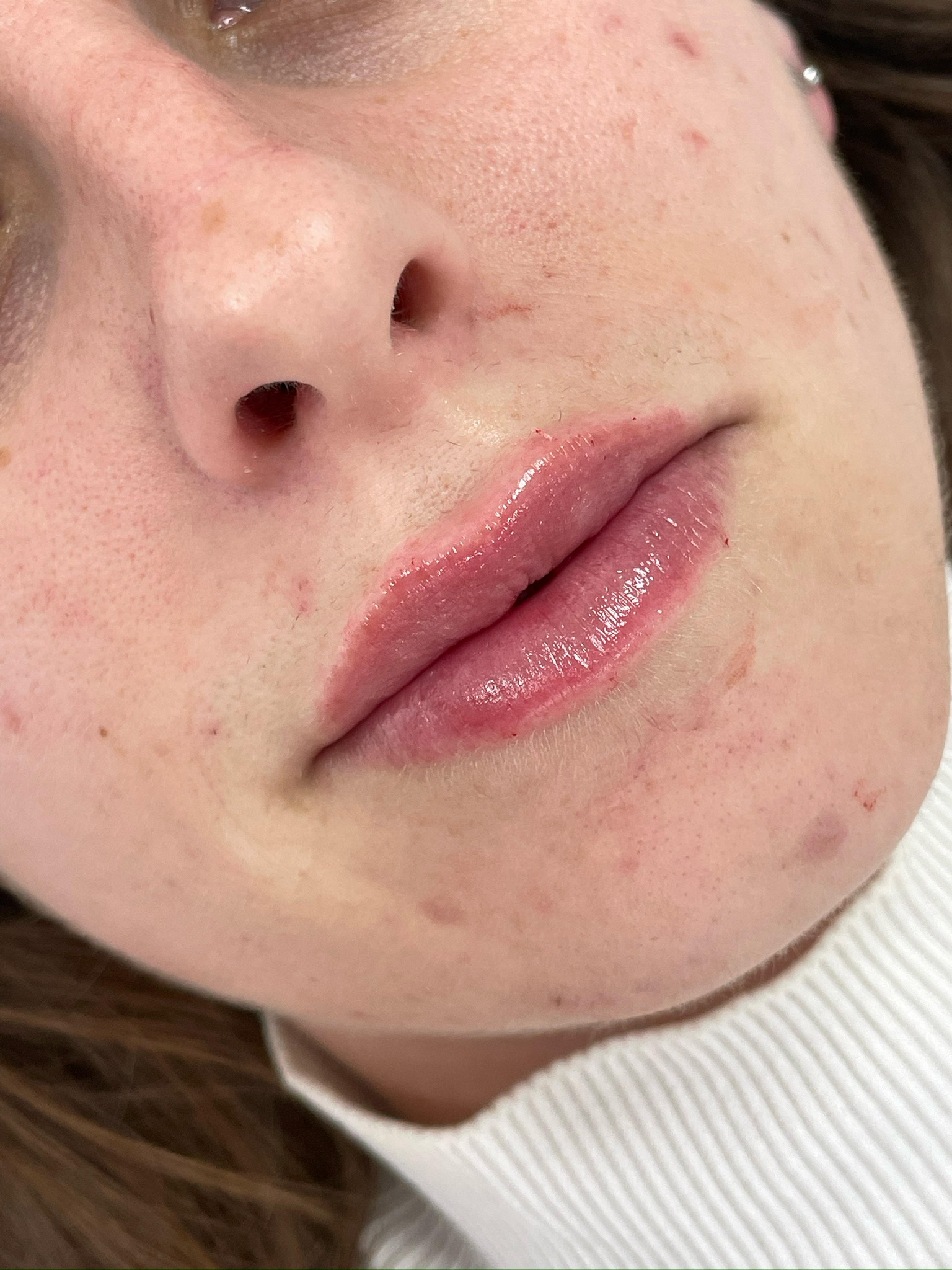 Tratamiento aumento de labios después