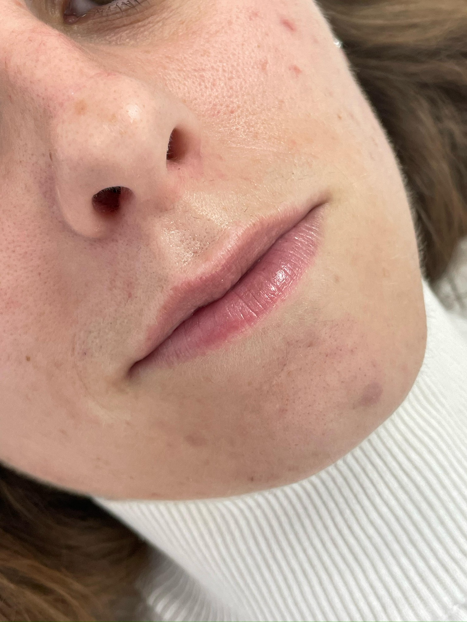 Tratamiento aumento de labios