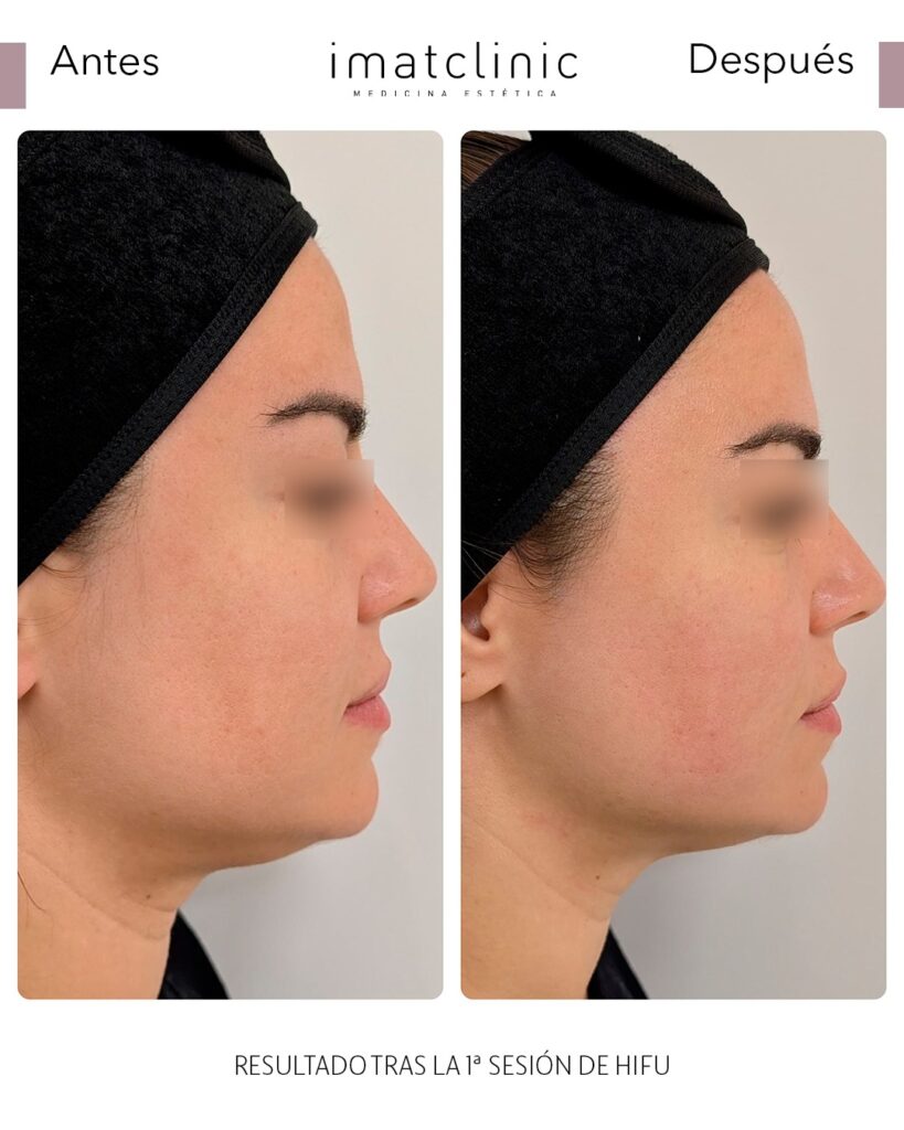 lifting facial sin cirugia