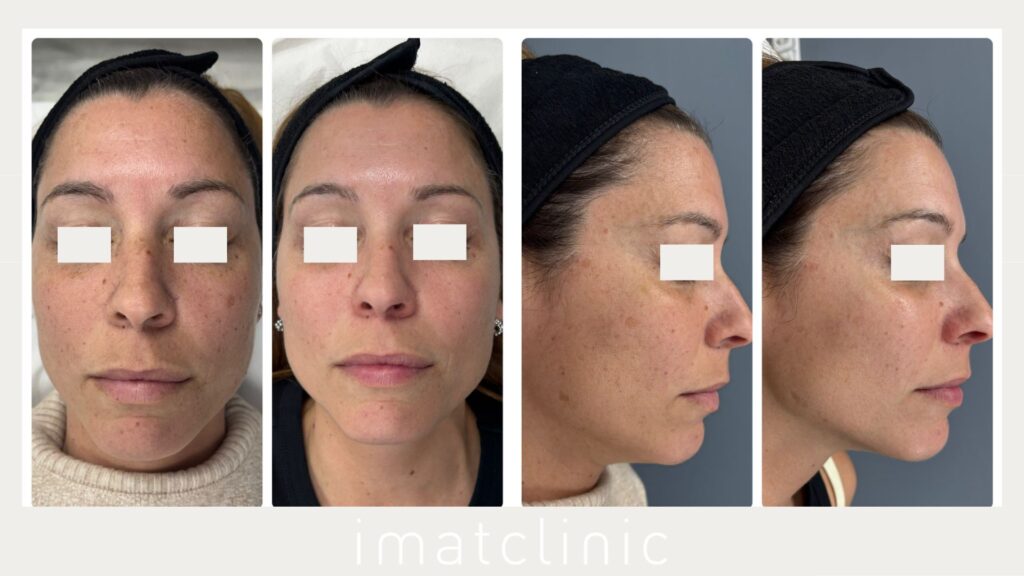 Cómo quitar las patas de gallo: Causas y los 4 tratamientos médicos más efectivos