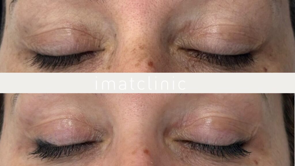 Quitar patas de gallo