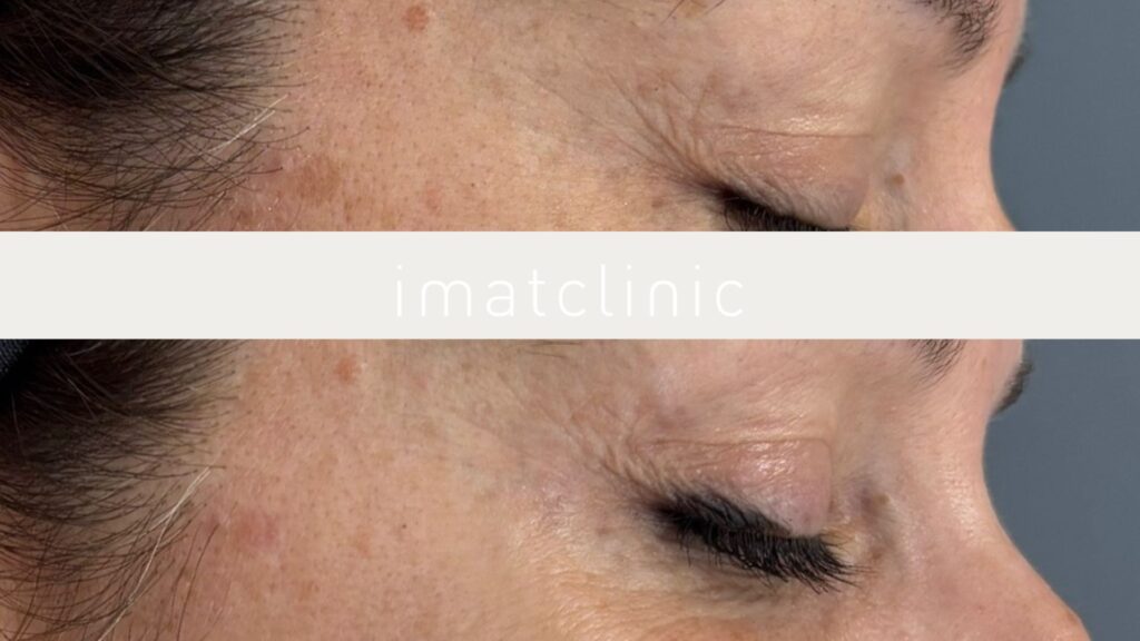 tratamientos patas de gallo