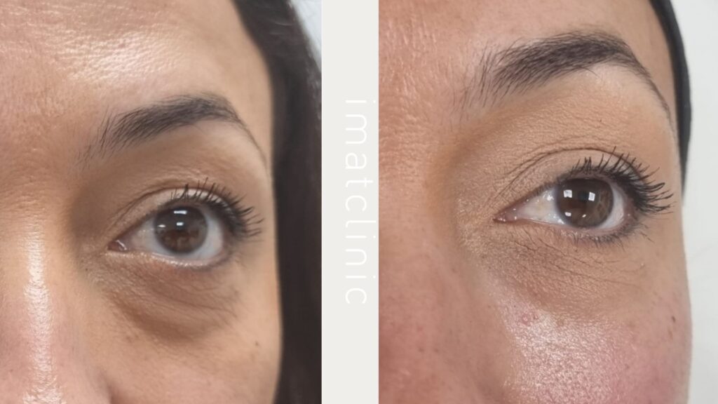 Ácido hialurónico para bolsas y ojeras en Barcelona