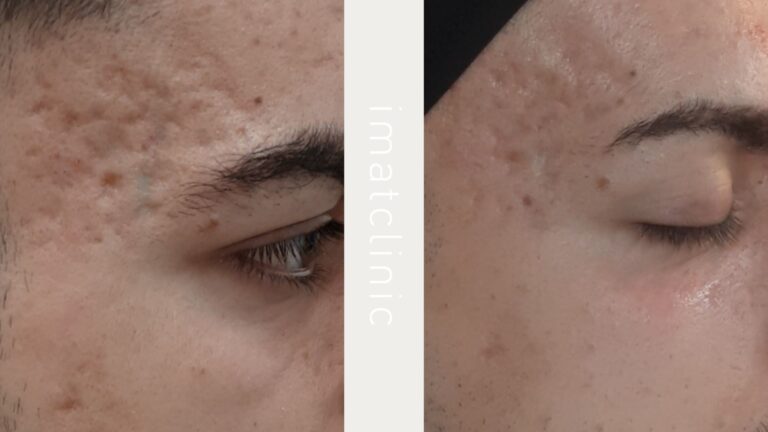 antes y despues del microneedling
