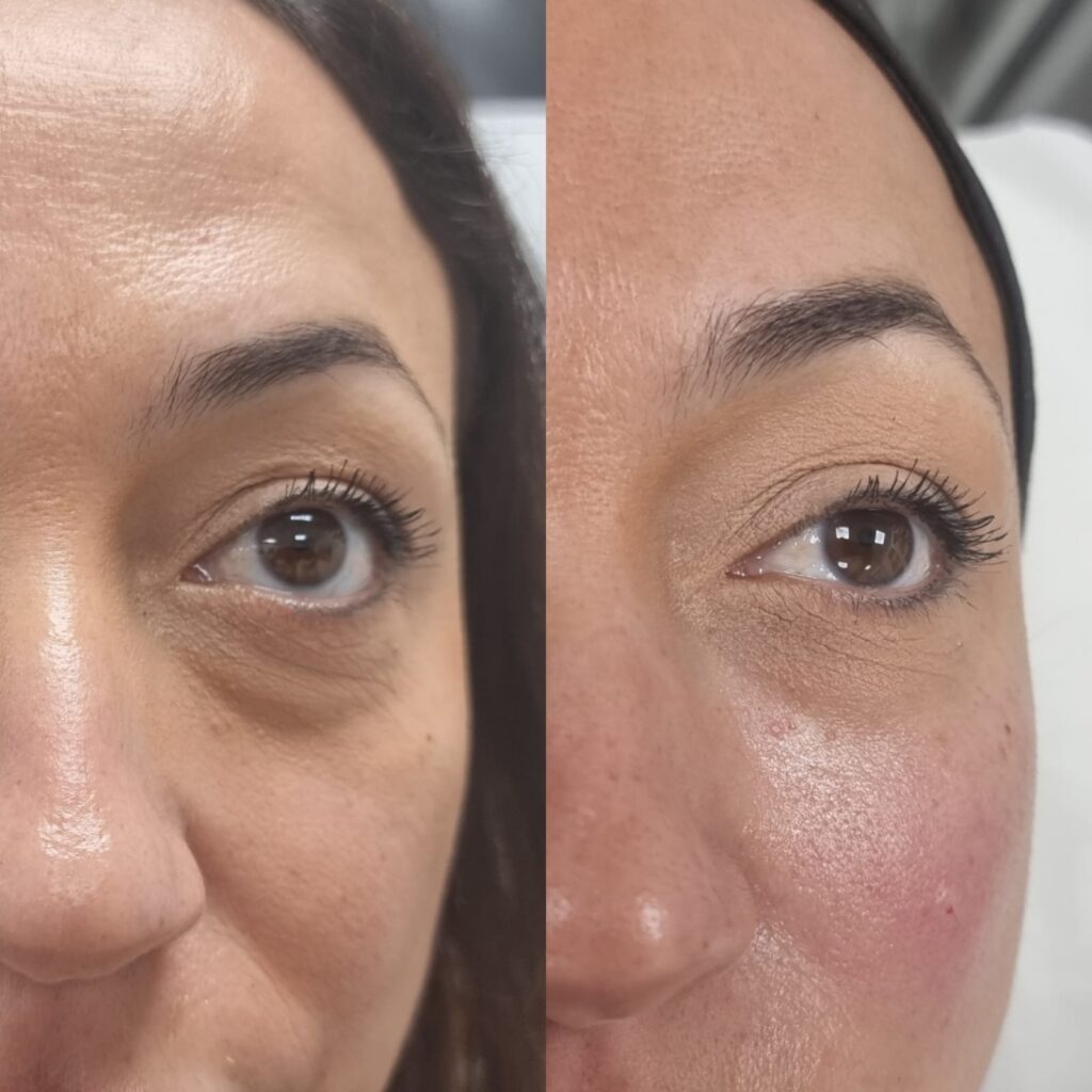 Tratamiento para eliminar Ojeras y Bolsas con ácido hialurónico