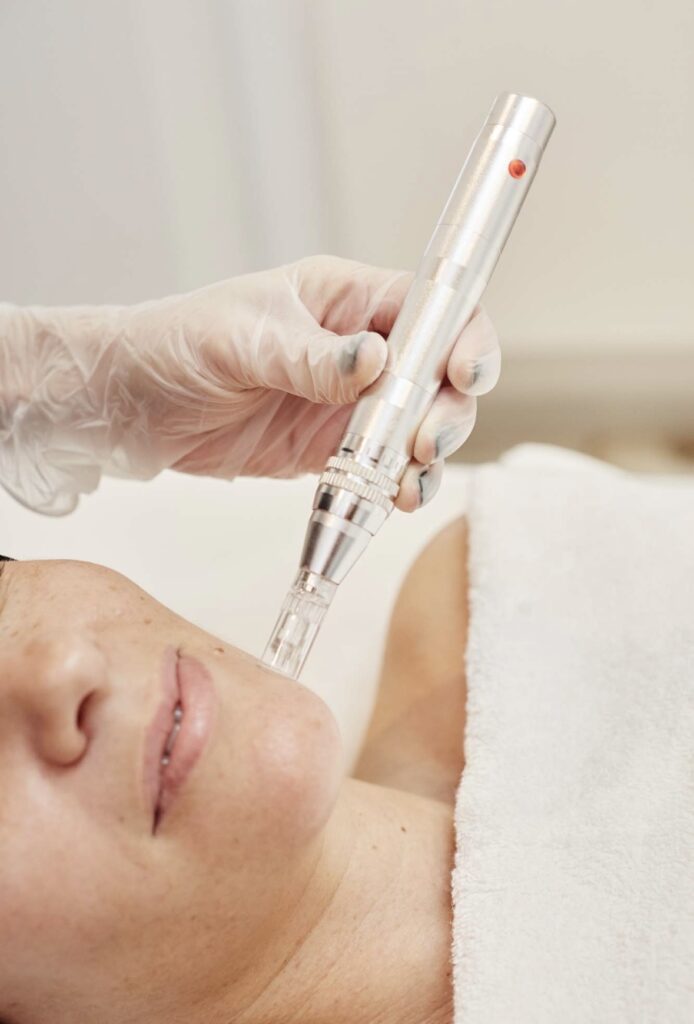 microneedling piel apagada