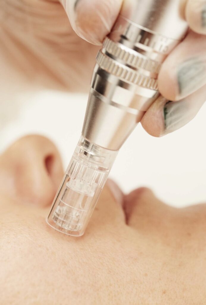 Tratamiento para poros abiertos: Causas y cómo tratarlos