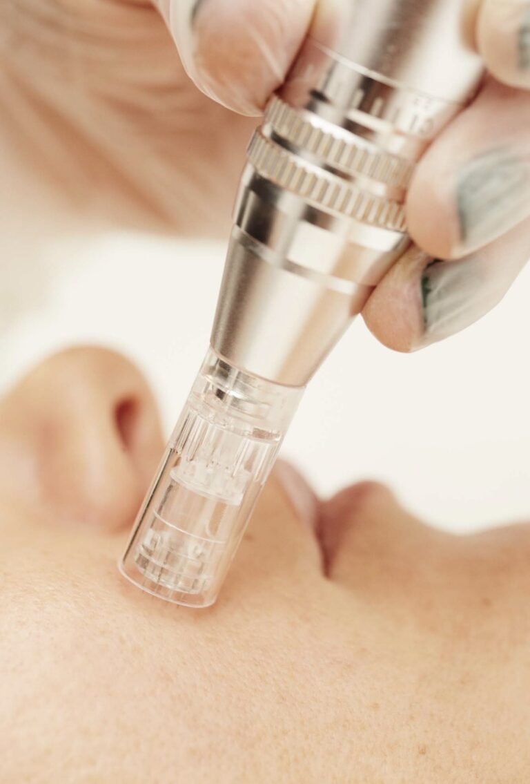 Tratamiento para poros abiertos: Causas y cómo tratarlos