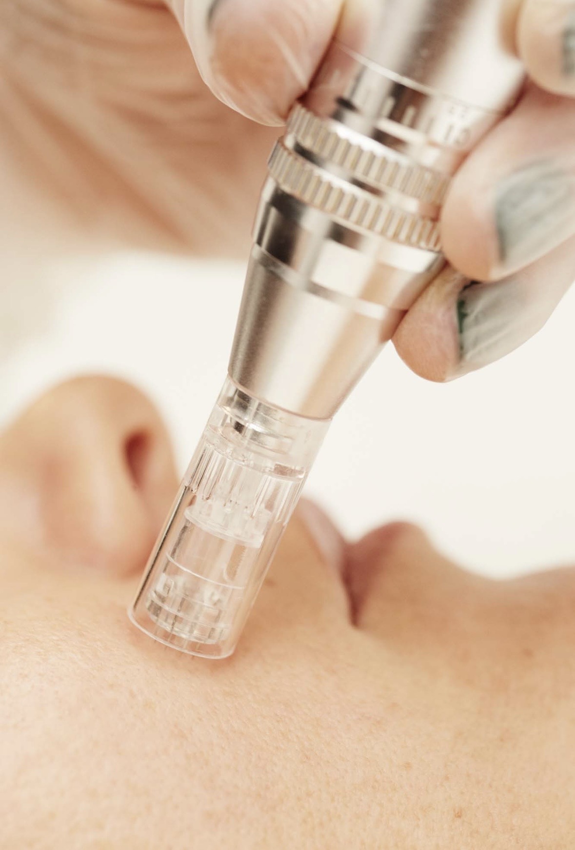 Tratamiento para poros abiertos: Causas y cómo tratarlos