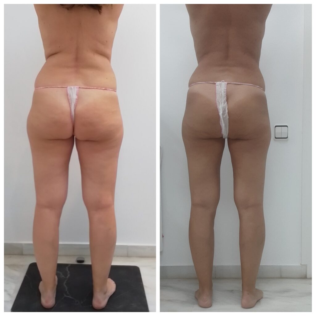 como eliminar grasa abdominal