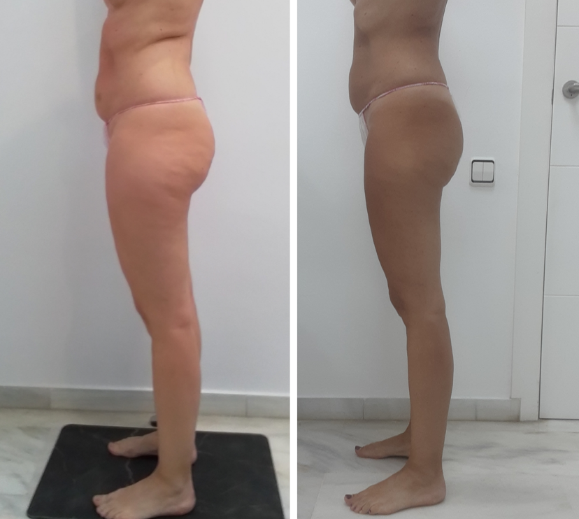 tratamiento Sculptor