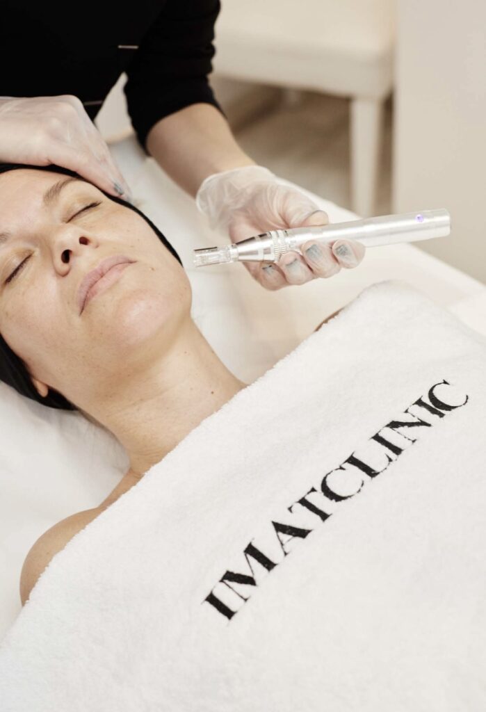 Microneedling para poros abiertos