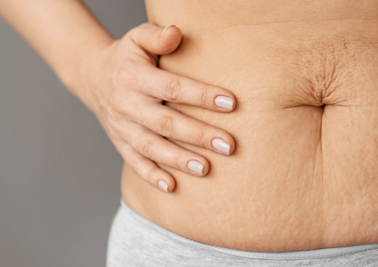 Cómo Eliminar la Flacidez Abdominal Sin Cirugía