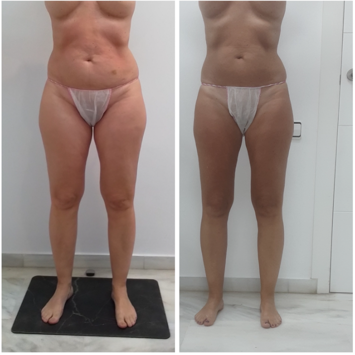 Body Sculpt para eliminar flacidez en los brazos