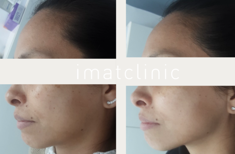 Manchas en la cara: tipos, causas y los mejores tratamientos