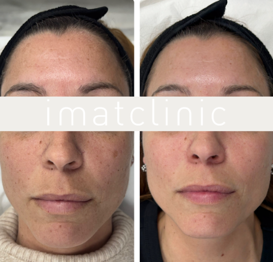 eliminar las manchas en la cara