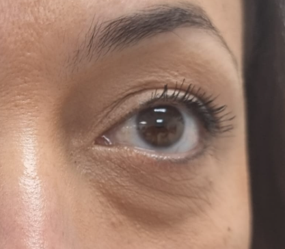 Mirada Cansada: Causas, Síntomas y los Mejores Tratamientos para Rejuvenecer tu Mirada