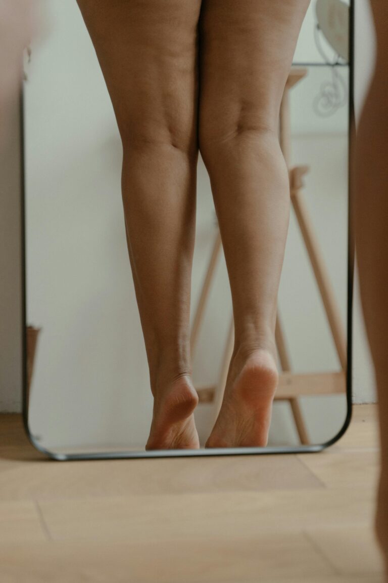 Lipedema: qué es, síntomas, grados y cómo tratarlo